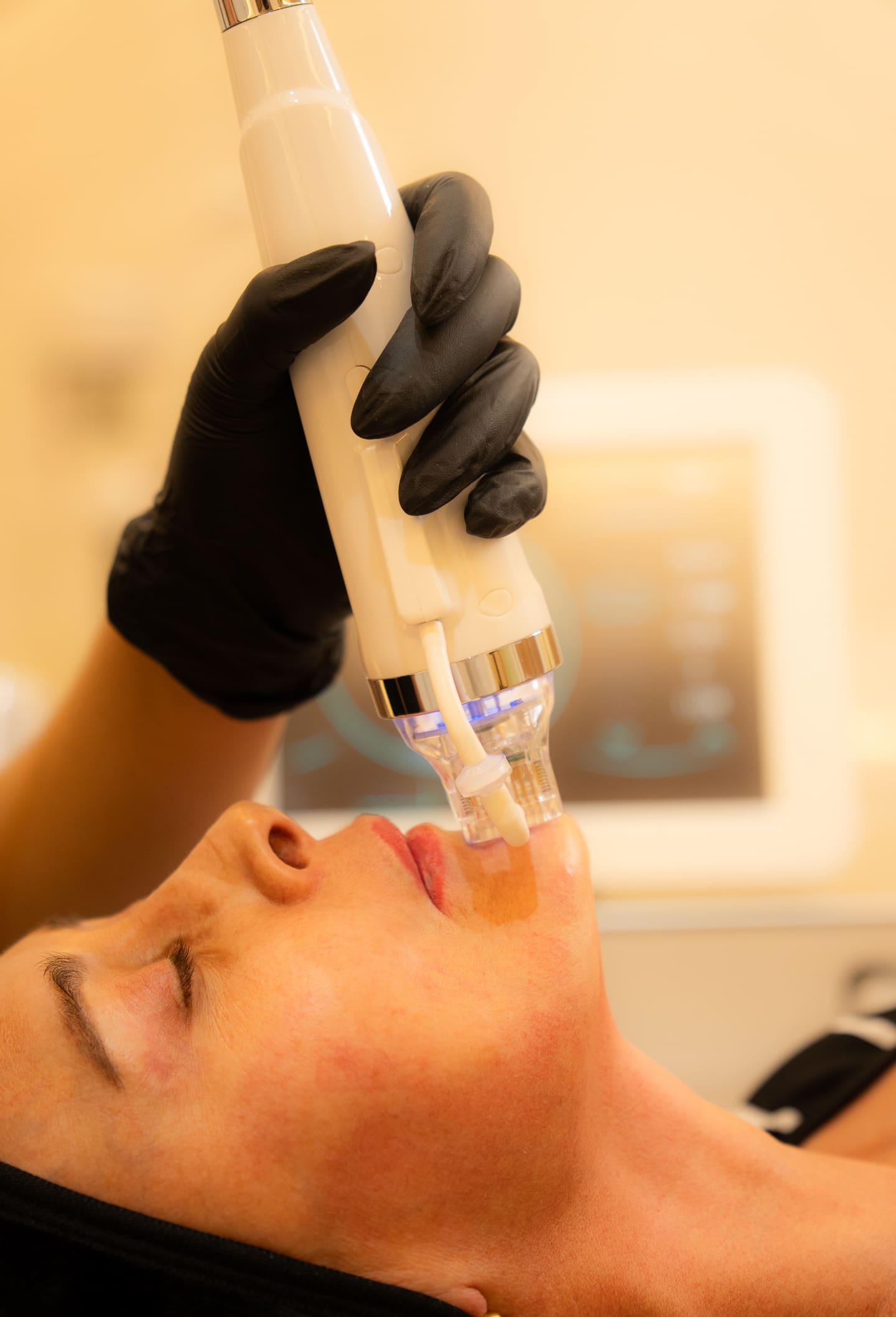 Primer plano del aparato de Hydrafacial en acción sobre el rostro de una clienta